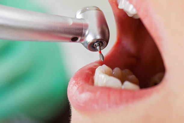 Best Emergency Tooth Extraction in Childersburg, AL